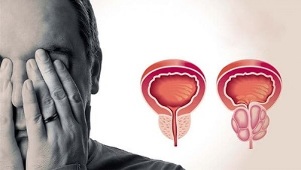 a prosztatagyulladás okai a férfiaknál