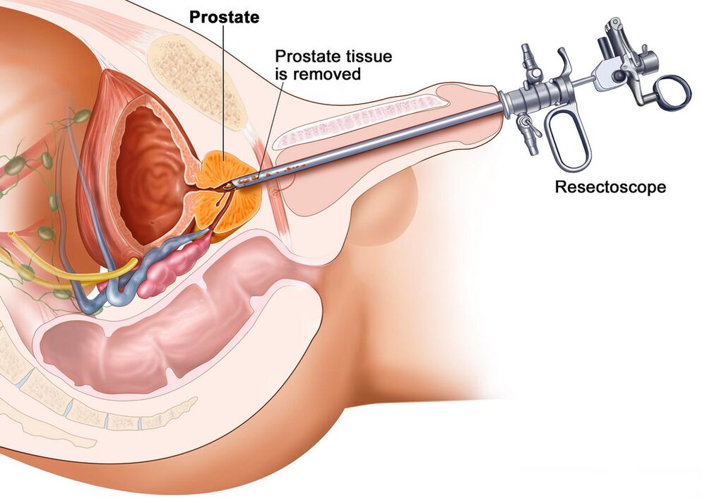 Prosztataszövet gyűjtése a prosztatagyulladás pontos diagnosztizálásához